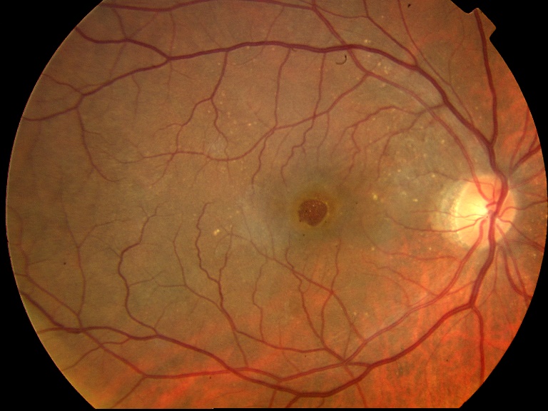 agujero macular