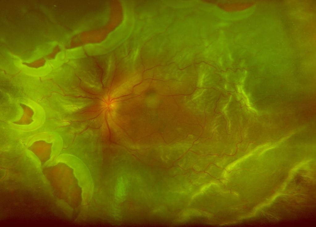 Desprendimiento de retina: sintomas, causas, operación, tratamiento
