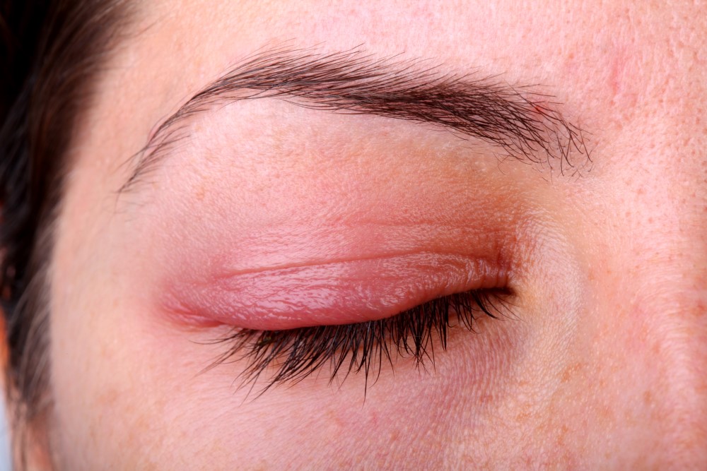 Blefaritis: Qué es, síntomas y tratamiento de la Blefaritis - Vissum