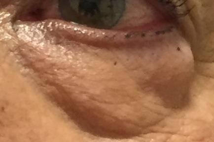 Bolsas en los ojos: Operacion, cirugía, tratamiento de dermatocalasia