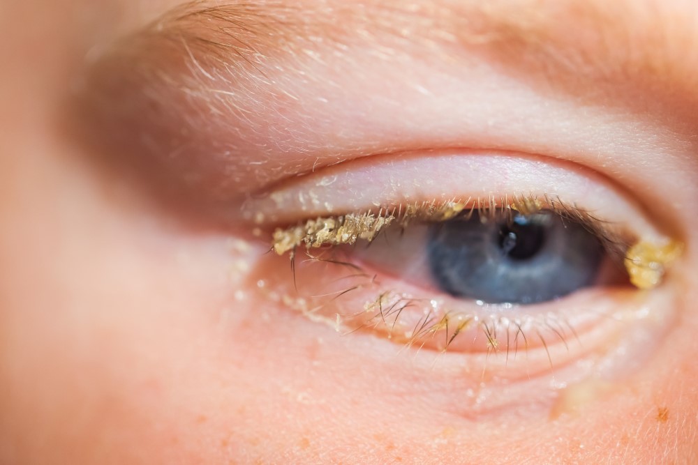 Conjuntivitis: Qué es, tratamiento, síntomas de conjuntivitis - Vissum