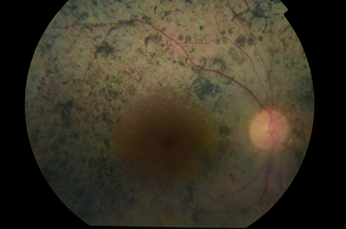 Retinosis pigmentaria: Qué es, tratamiento, sintomas, causas, cirugía