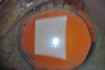 Aniridia: Qué es, síntomas y el tratamiento de la Aniridia - Vissum