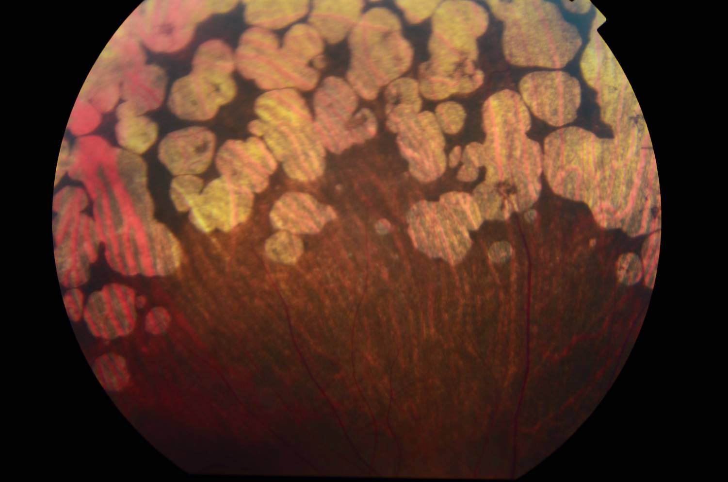 Distrofia retiniana: Qué es, causas y tratamiento - Vissum
