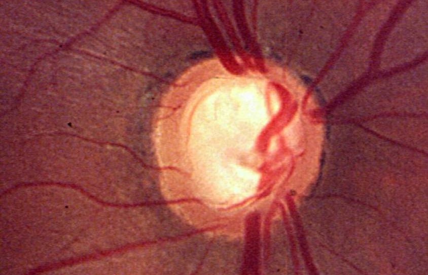 Cirugía Glaucoma - Glaucoma operación - Vissum
