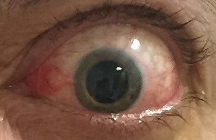 Oftalmopatía tiroidea: Qué es, causas, tratamiento - Vissum