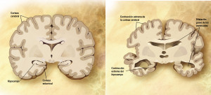 Comparativa entre un cerebro sano y uno con la enfermedad de Alzheimer