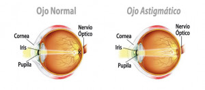 Representación gráfica del astigmatismo miópico