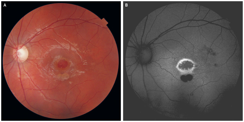 Agujero macular por puntero láser. | NEJM